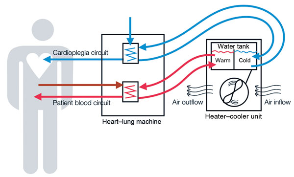 Diagram of how a heart-lung machine sends blood through a heater-cooler unit
